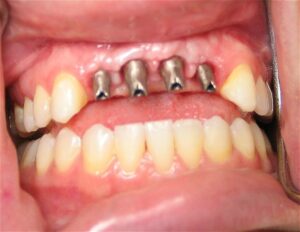 Dantų implantai