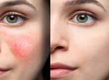 kapiliarų šalinimas lazeriu kaune